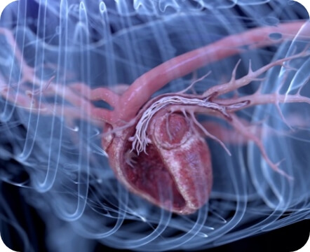 A graphic depicting a heartworm infection